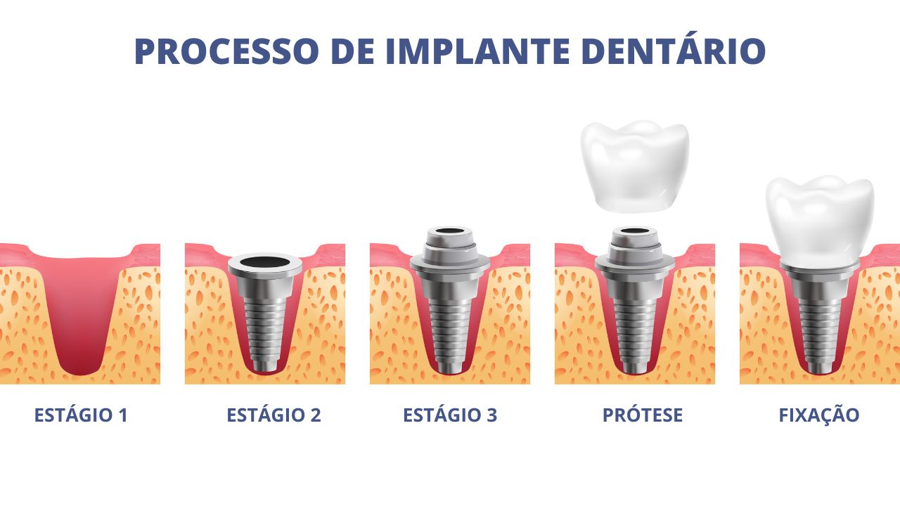 processo de implante dentário