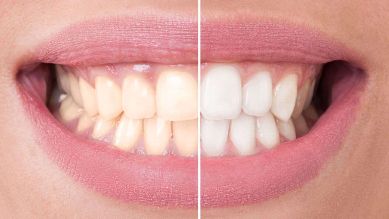 lente de contato dental antes e depois