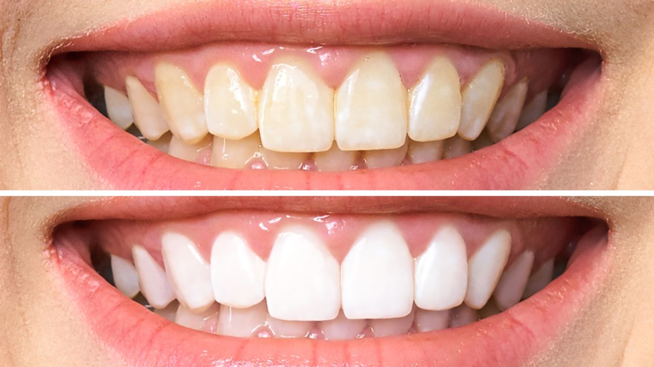 Clareamento Dental