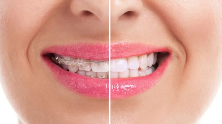 Aparelho ortodôntico antes e depois: confira as diferenças!