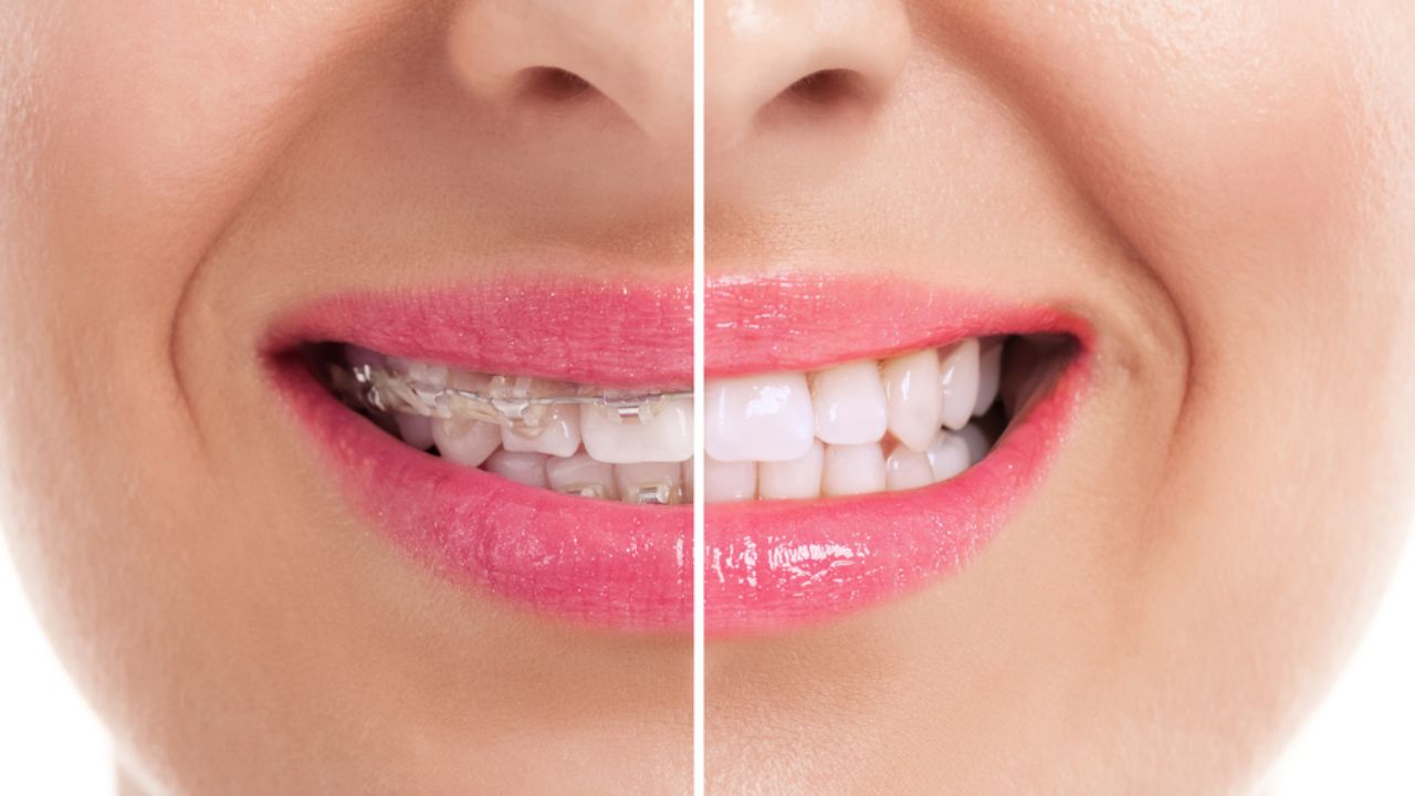 Aparelho ortodôntico antes e depois: confira as diferenças!