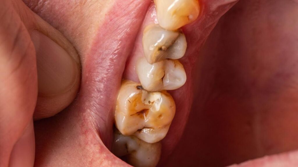 Quanto tempo a cárie demora para destruir o dente?