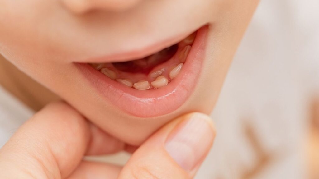 Como amolecer dente de leite mais rápido? Aprenda aqui!