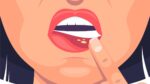 Sapinho na boca: causas, sintomas e tratamento - OralDents