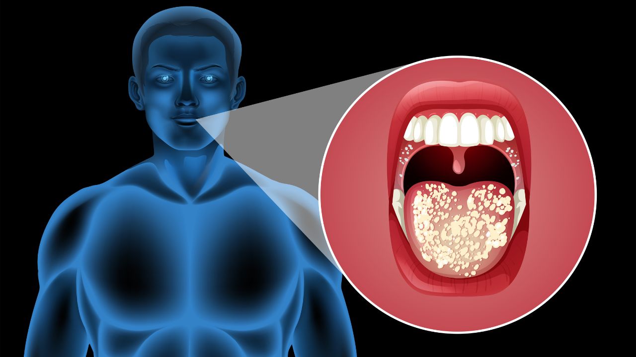 Tratamento para herpangina Tratamento para herpangina