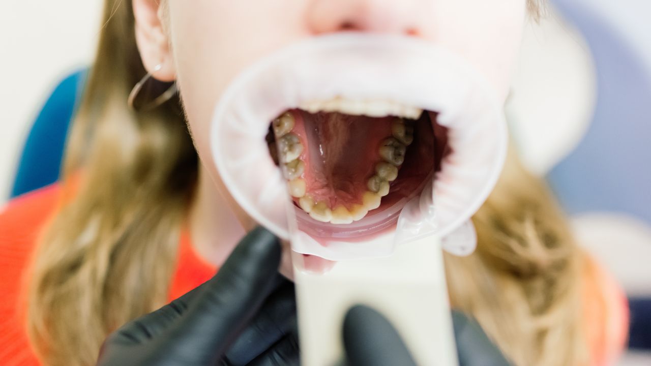 Como prevenir a Periodontite apical aguda