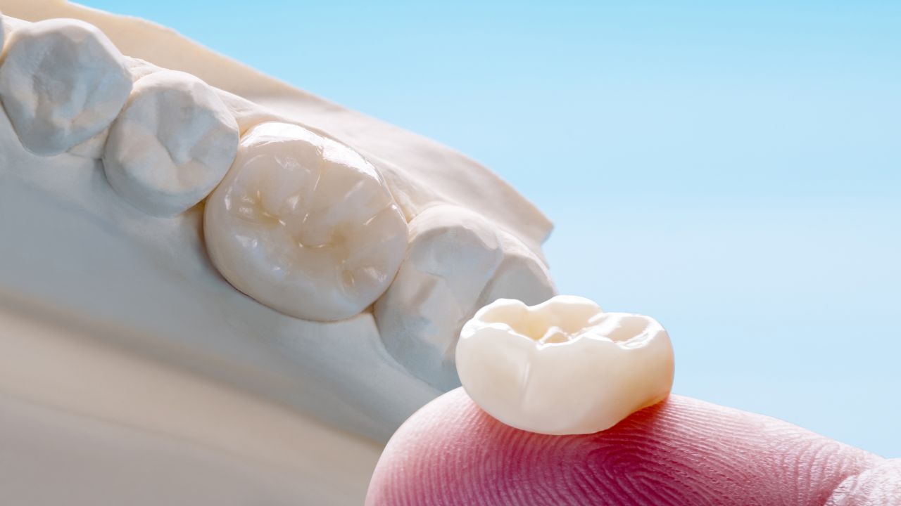 Quanto custa uma coroa dentária Quanto custa uma coroa dentária