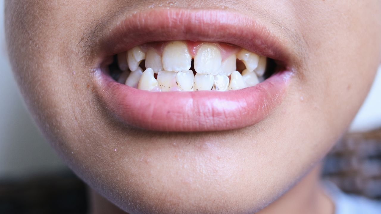 Principais causas dos dentes desalinhados Principais causas dos dentes desalinhados