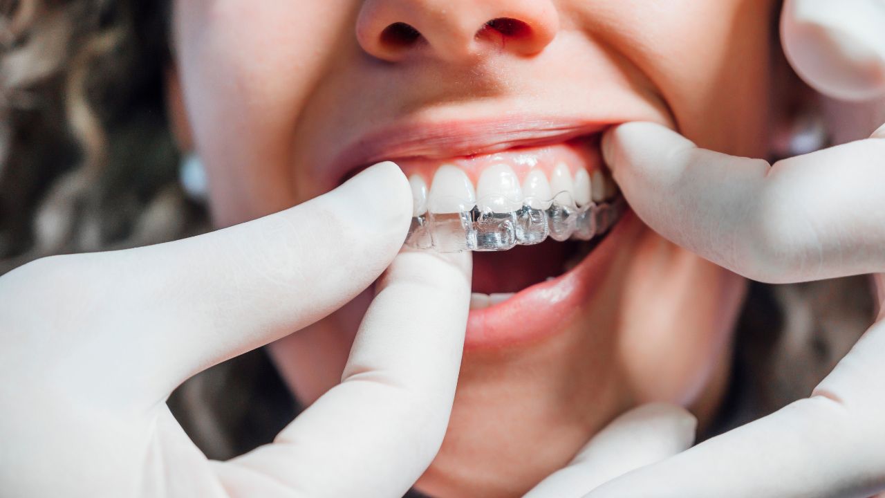 Como funciona o tratamento com Invisalign Como funciona o tratamento com Invisalign
