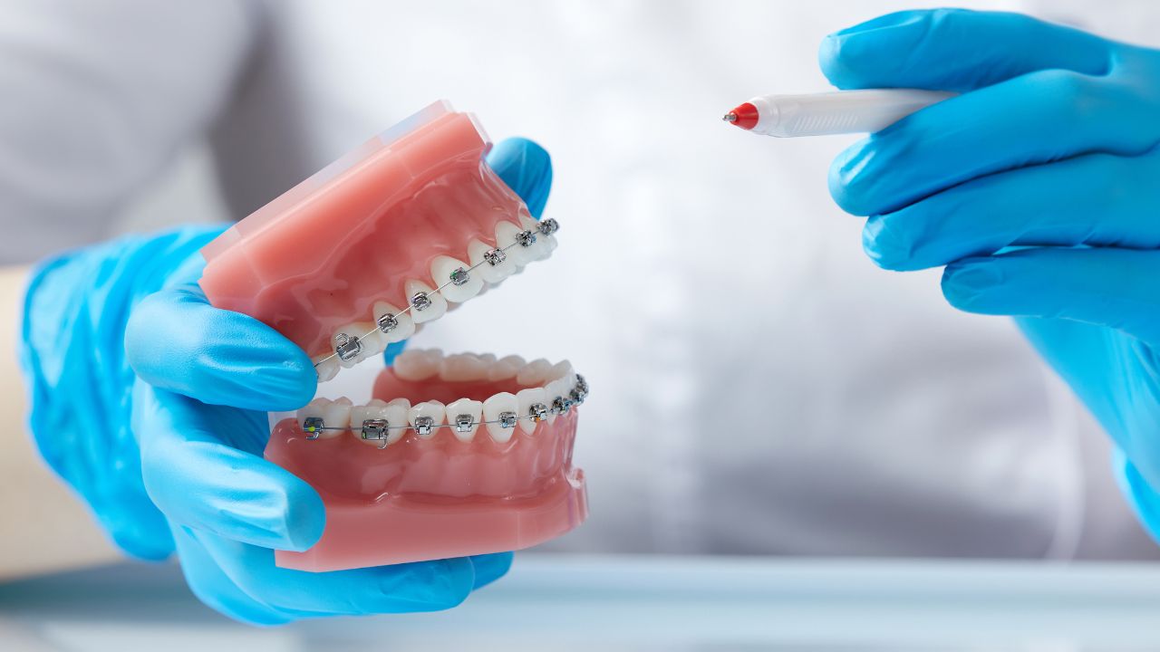 Indicações específicas para escolher entre Invisalign e aparelho fixo Indicações específicas para escolher entre Invisalign e aparelho fixo