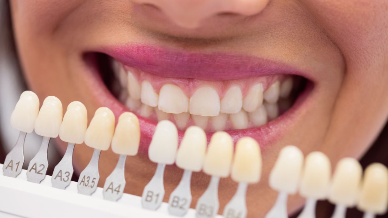 Materiais e aplicação das lentes de contato dental