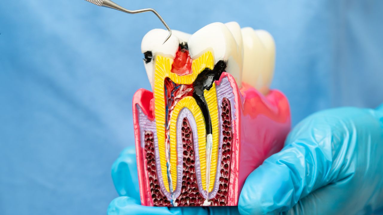 dente com cárie doendo dente com cárie doendo