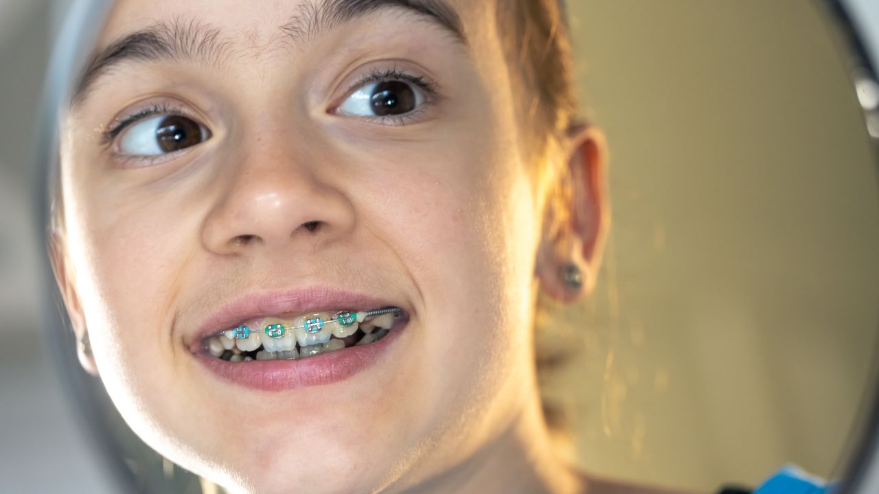 Cuidados diários para evitar dentes amarelados com aparelho