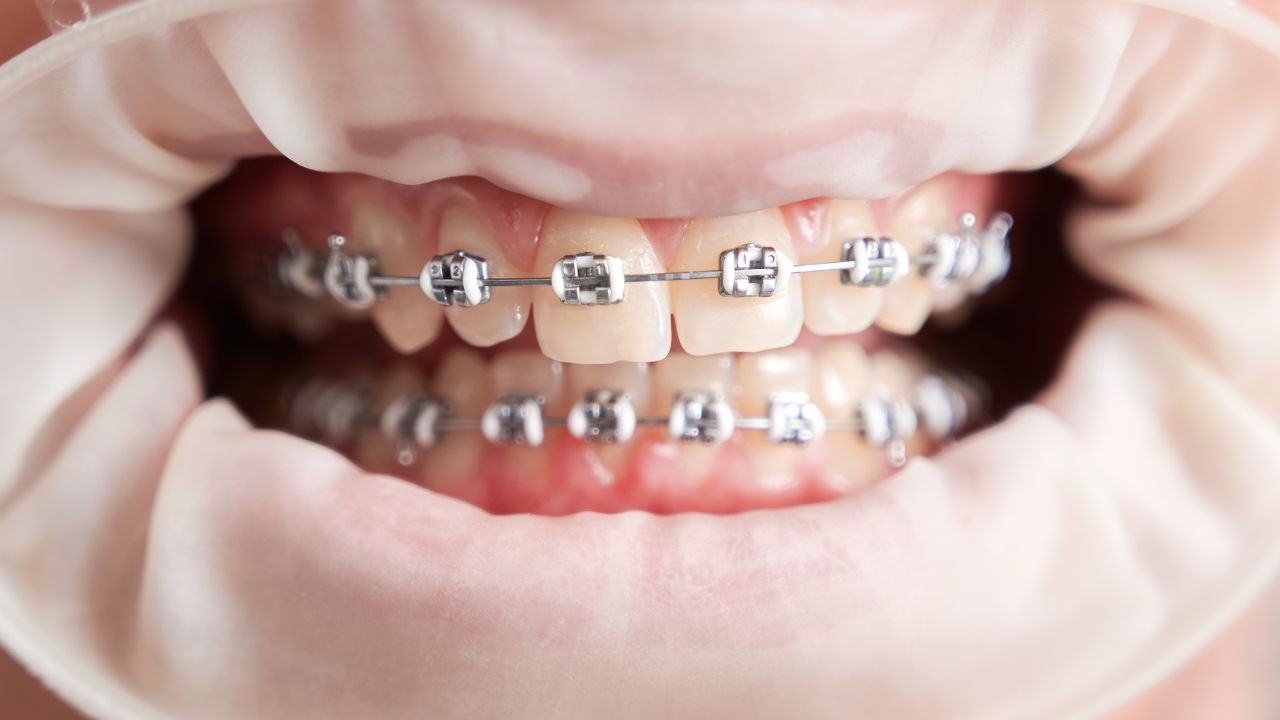 Dúvidas frequentes sobre dentes amarelados com aparelho