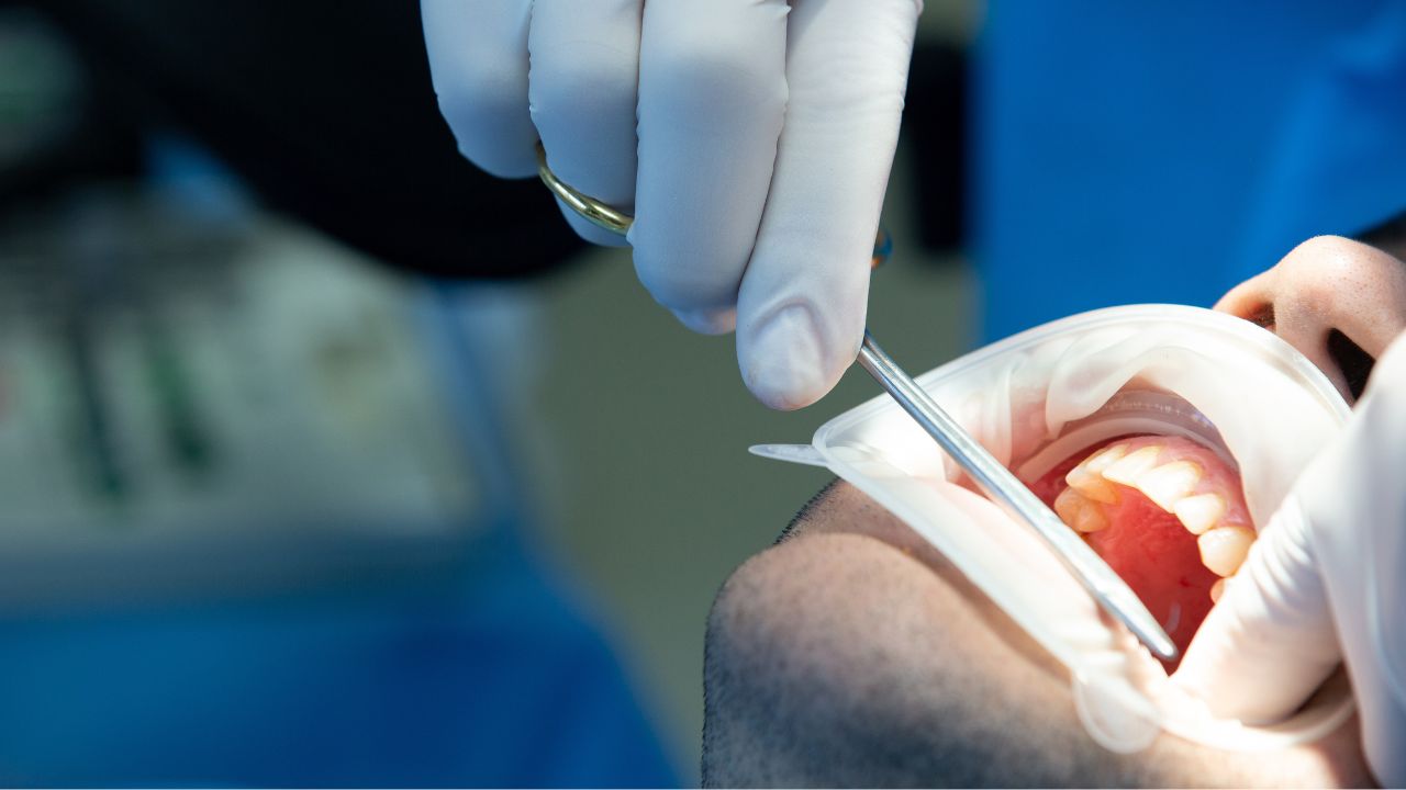 Perda do dente_ a consequência mais comum de não tratar o canal